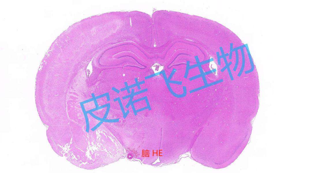 HE染色在腫瘤惡性程度判斷中的重要性