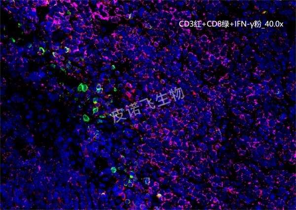 CD3紅+CD8綠+IFN-γ粉 腫瘤