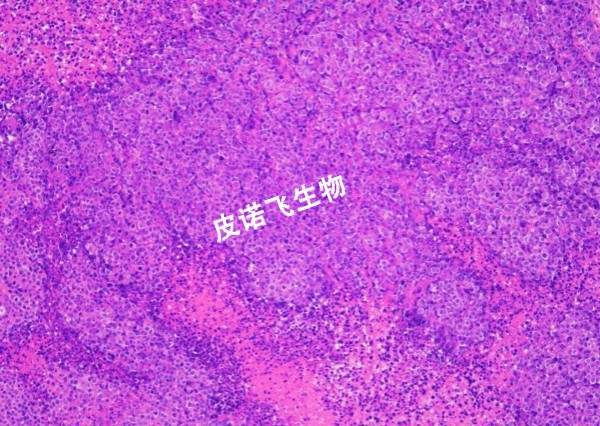 腫瘤HE